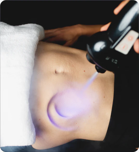 cryo slimming
