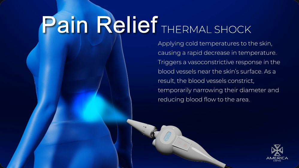 pain relief cryo monmouth county nj